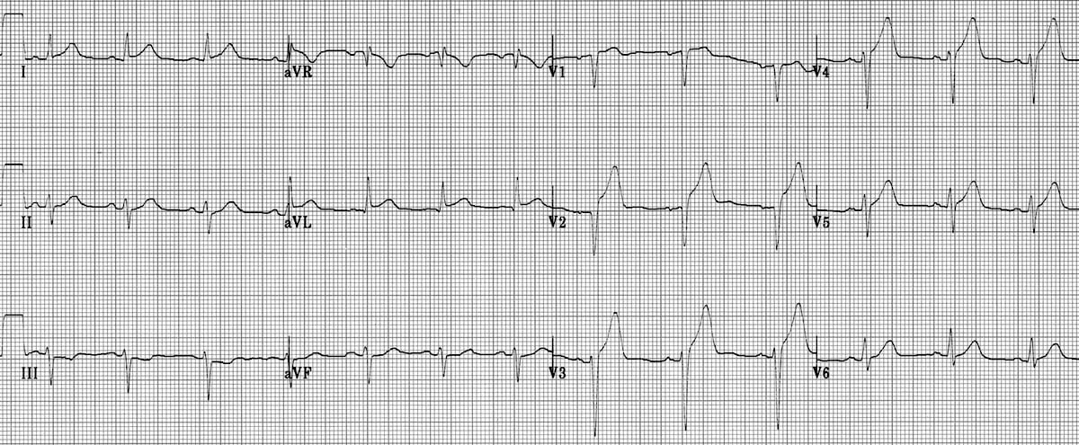 Anterior STEMI ECG