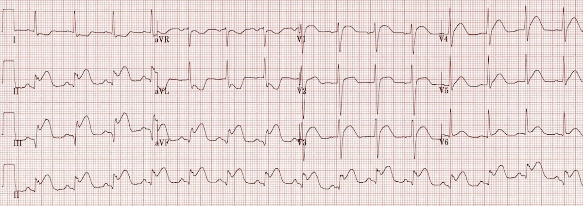 Inferior STEMI ECG