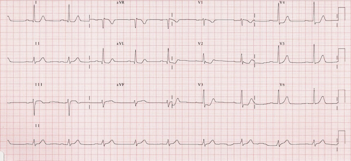 Posterior STEMI ECG