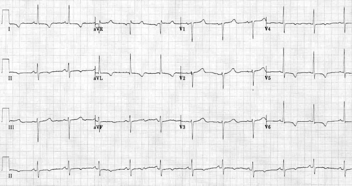 NSTEMI with T-wave inversion
