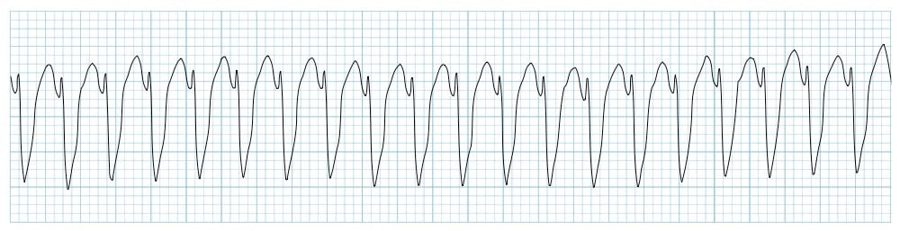 Ventricular Tachycardia ECG