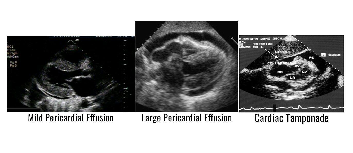Cardiac Tamponade ECHO