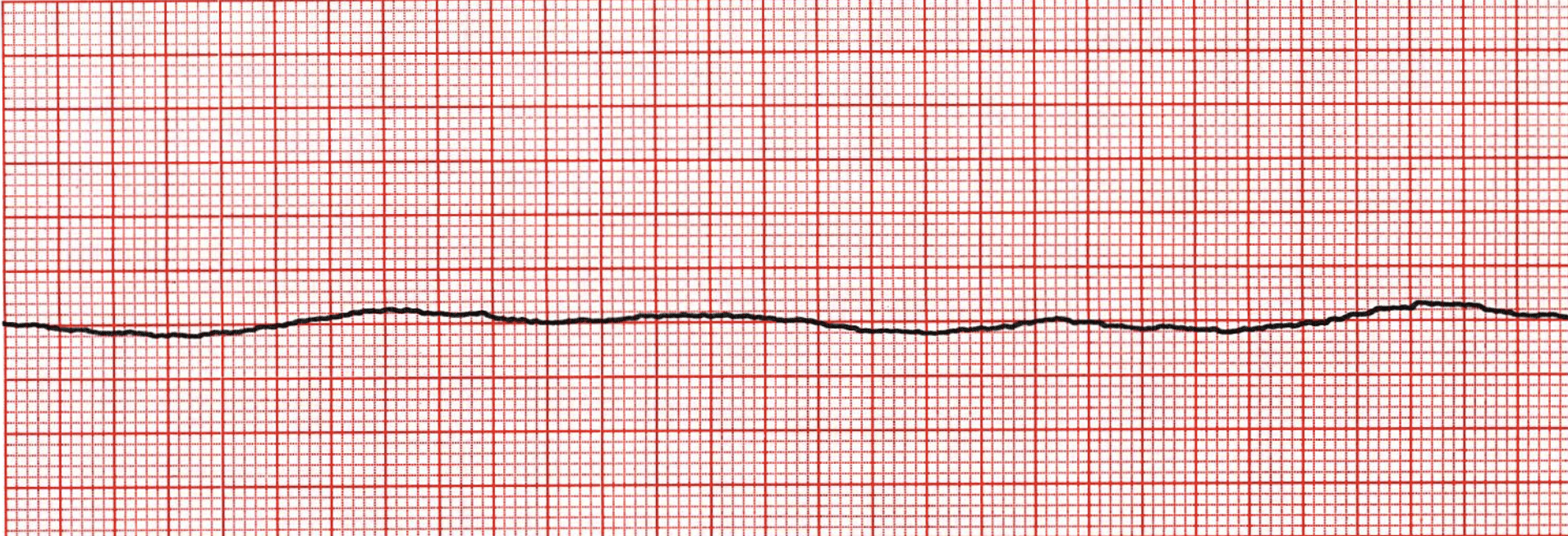 Asystole ECG