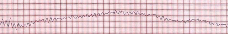 Ventricular Fibrillation ECG