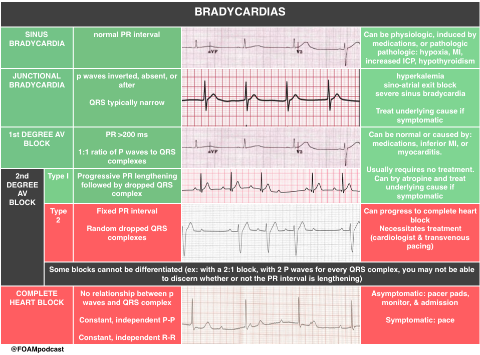 Bradycardia ECG Patterns