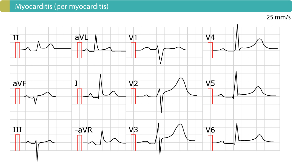 Acute Pericarditis ECG